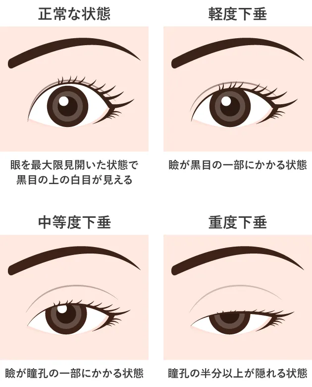 眼瞼下垂イラスト