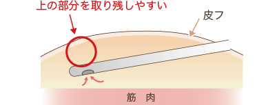 クリスクロス法の3次元利用を説明した脂肪吸引の図