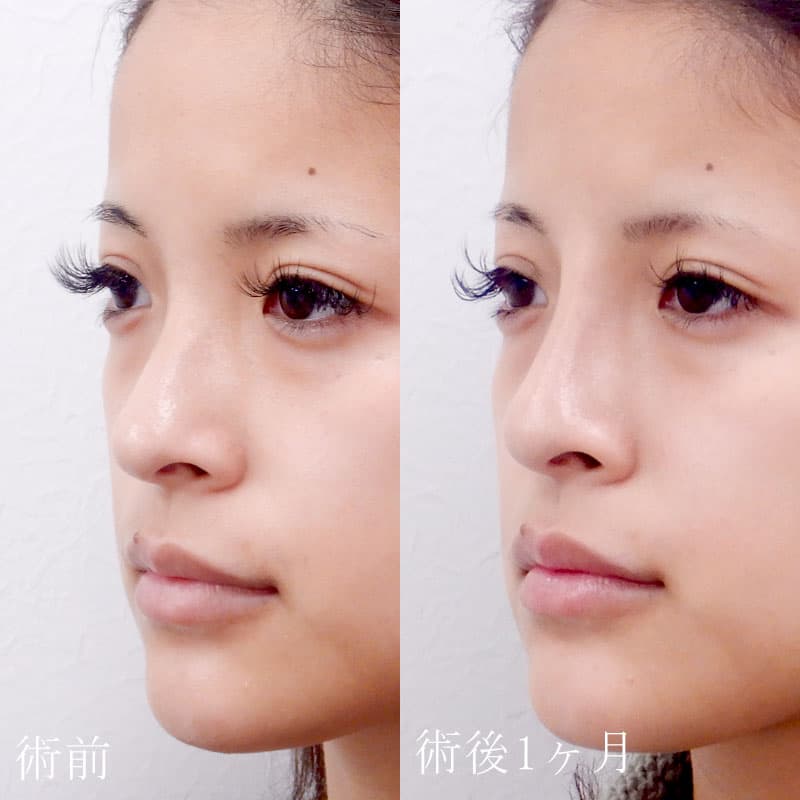 鼻プロテーゼの症例写真