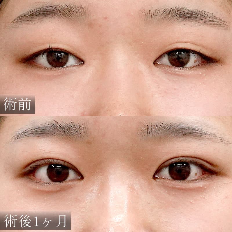 自然癒着法の症例写真