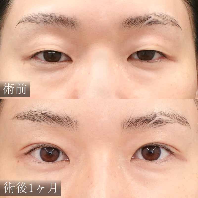 水の森美容美容クリニック自然癒着法太田医師の症例