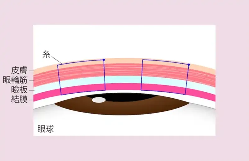 当院の2線留め