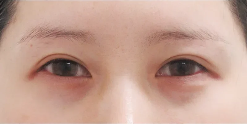 目尻切開施術前