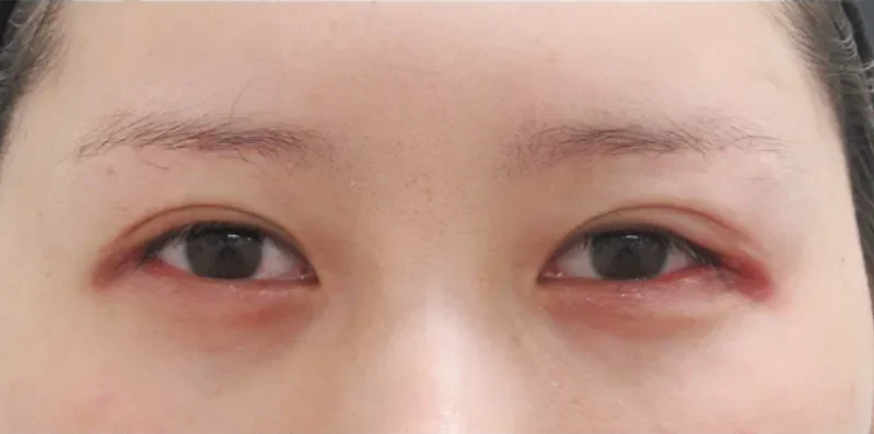 目尻切開施術1週間後