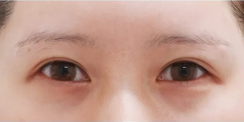 目尻切開施術1ヶ月後