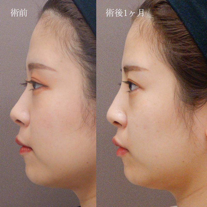 鼻プロテーゼの症例写真
