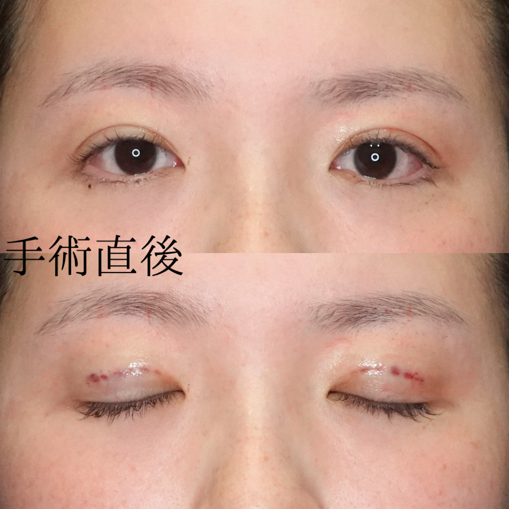 自然癒着法手術直後の画像