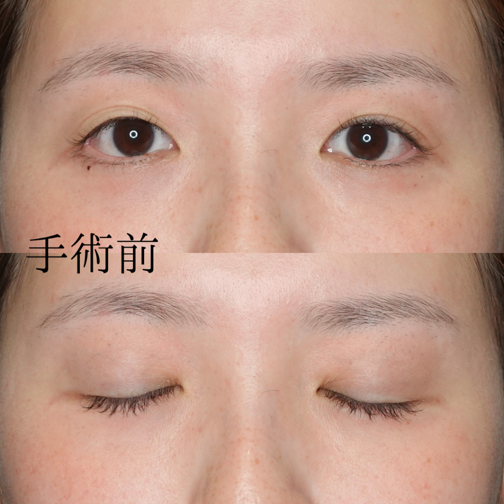 自然癒着法手術前の写真
