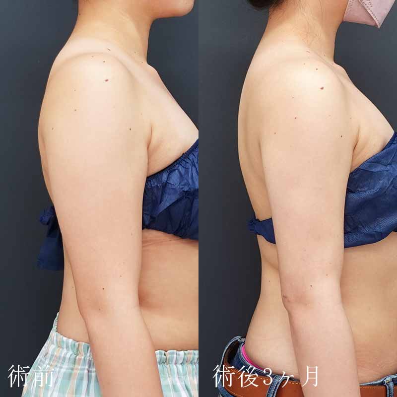 大阪梅田院里院長の二の腕の脂肪吸引症例写真