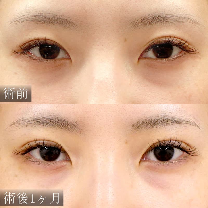 自然癒着法の症例写真