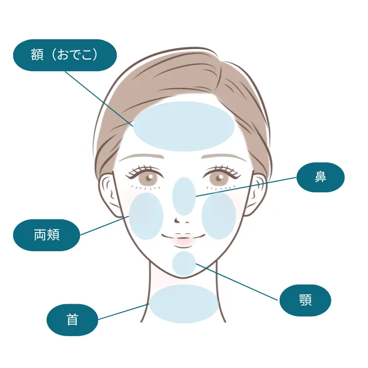 スキンボトックスの注入箇所をあらわしたイラスト