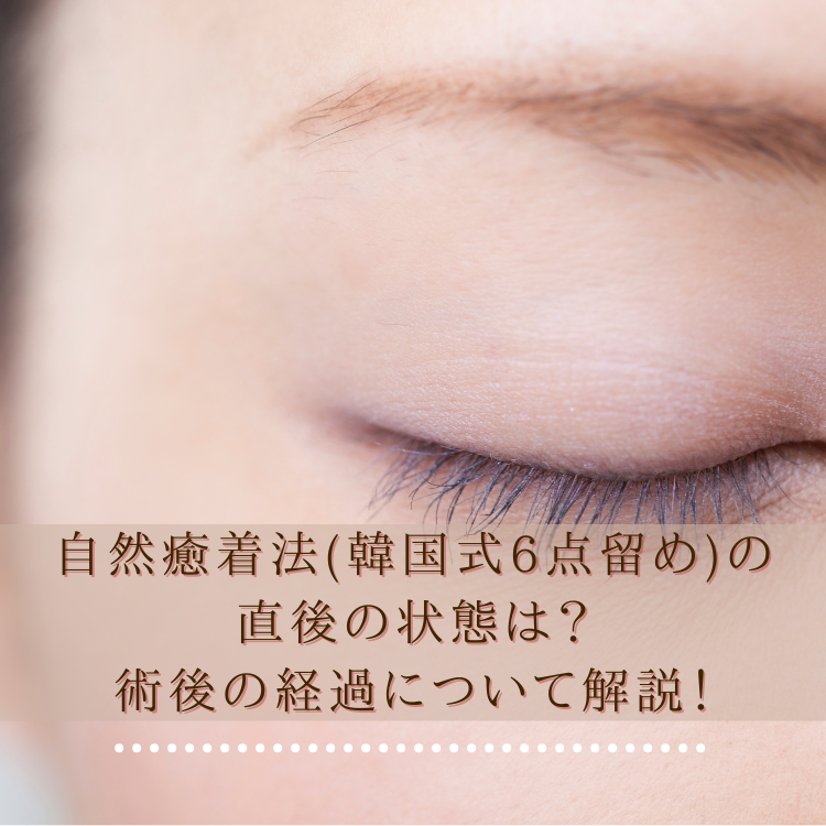 自然癒着法(韓国式6点留め)の 直後の状態は？ 術後の経過について解説！