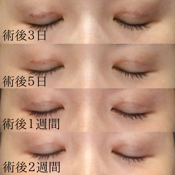 自然癒着術後の赤みの変化