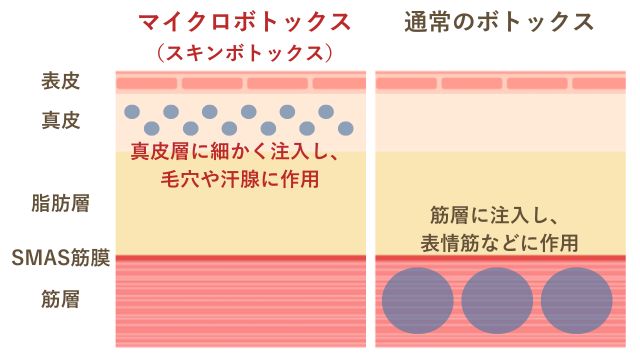 スキンボトックスと通常のボトックスの注入層の違い