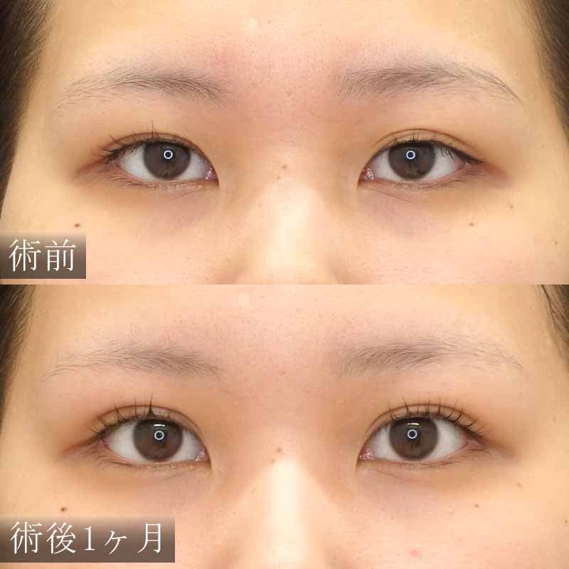 渋谷院 村上医師の自然癒着法症例写真