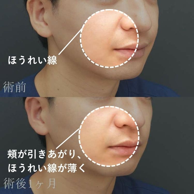 ハイフの術前と術後1カ月のビフォーアフター画像
