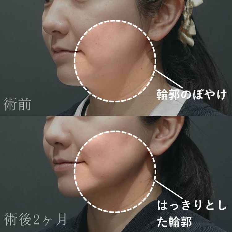 ハイフの術前と術後2カ月のビフォーアフター画像