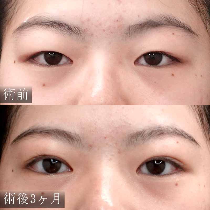 東京新宿院小糸院長の二重切開法