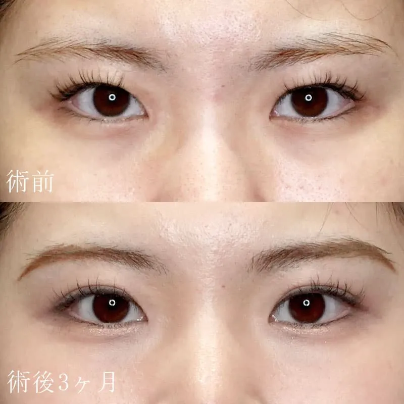 術前 術後3ヶ月