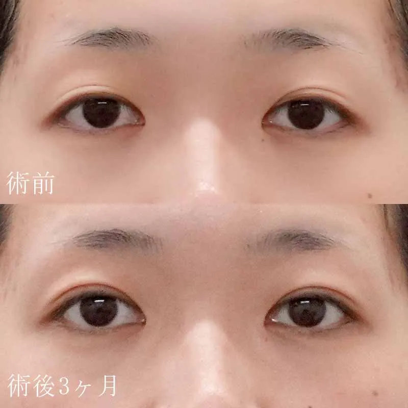 術前 術後3ヶ月