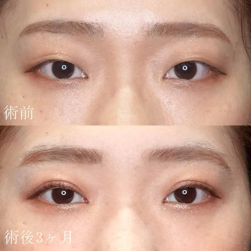 術前 術後3ヶ月