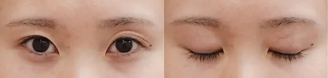 術前