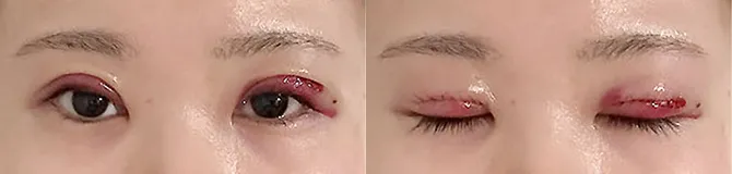 術後翌日