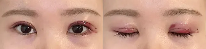 術後2日目