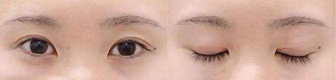術後30日目