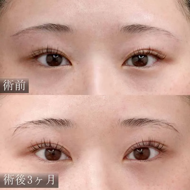 術前 術後3ヶ月