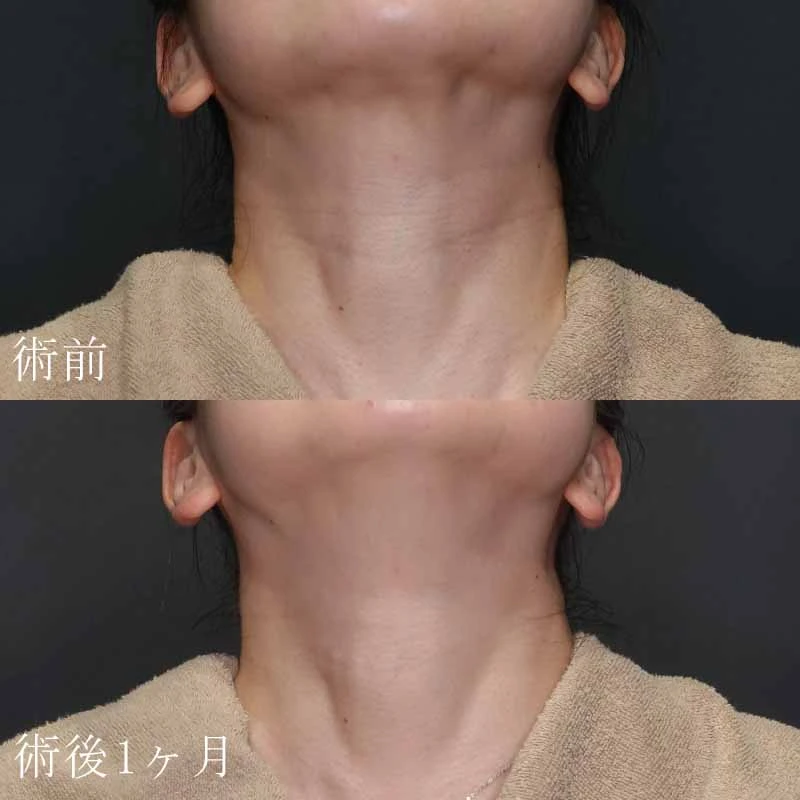 首のシワのヒアルロン酸