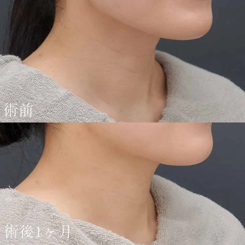 首のシワのヒアルロン酸