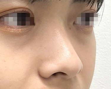 鼻のヒアルロン酸　術前