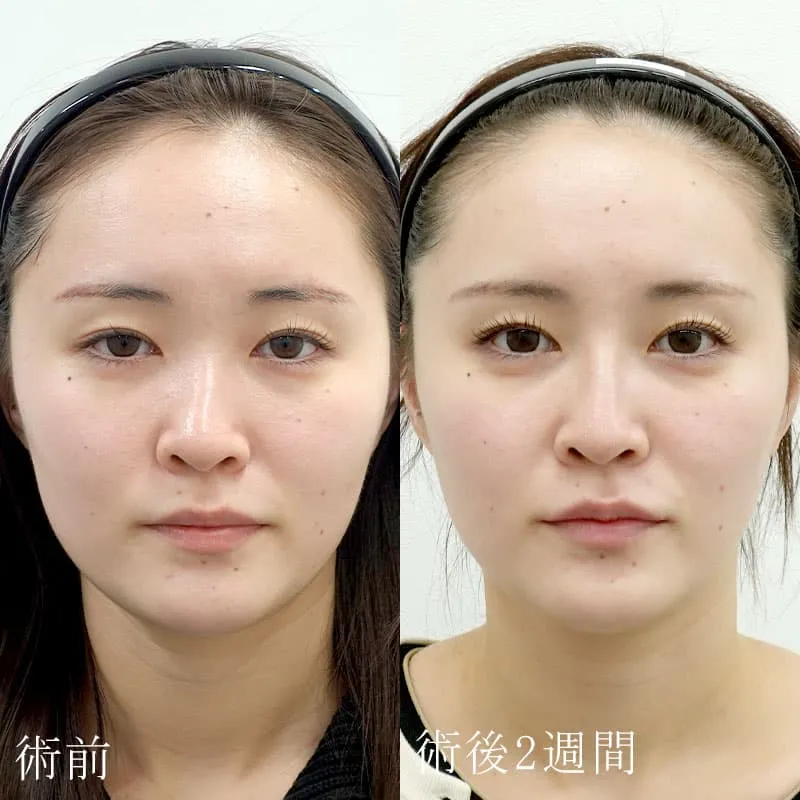 鼻・唇・涙袋のヒアルロン酸