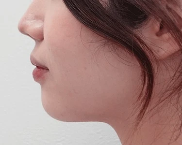 あごのヒアルロン酸　術前