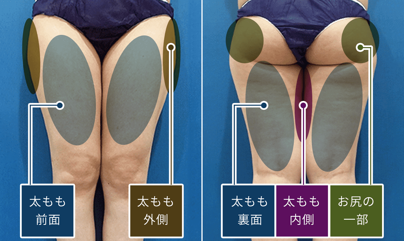 太もも前面、太もも外側、太もも裏面、太もも内側、お尻の一部