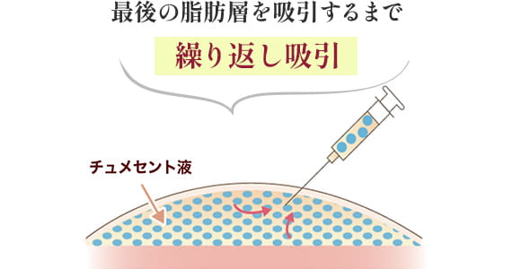 最後の脂肪層を吸引するまで繰り返し吸引