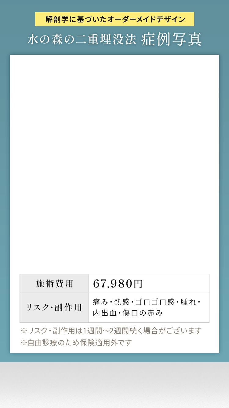 解剖学に基づいたオーダーメイドデザイン 水の森の二重埋没法 症例写真