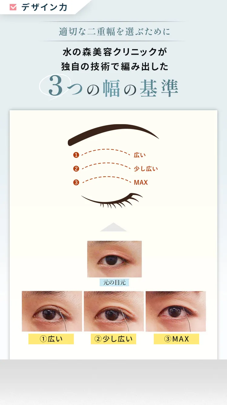 適切な二重幅を選ぶために水の森美容クリニックが独自の技術で編み出した3つの幅の基準①広い②少し広い③MAX