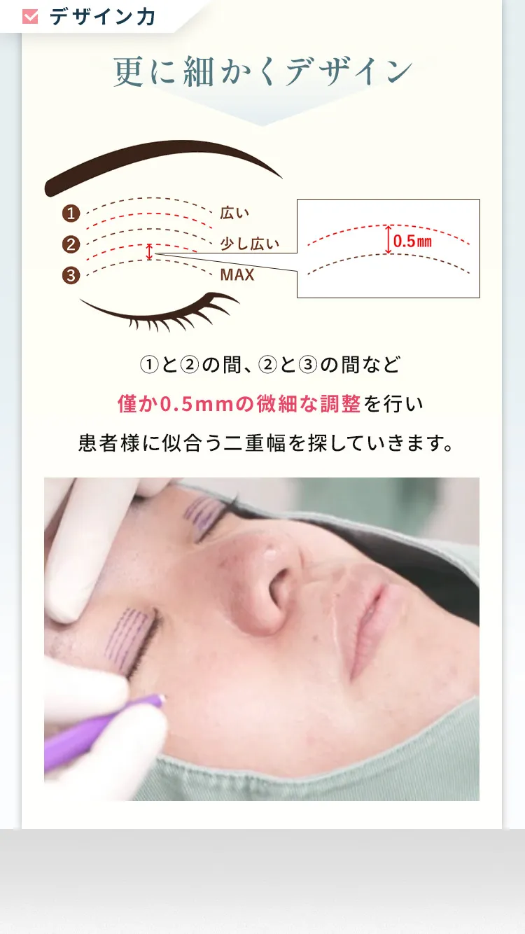 さらに細かくデザイン→①と②の間、②と③の間など僅か0.5mmの微細な調整を行い患者様に似合う二重幅を探していきます。「3つの幅を基準に骨格に合わせたデザインをオーダーメイドで形成 細部までこだわるデザイン技術こそが水の森の二重埋没法の最大の魅力です。」