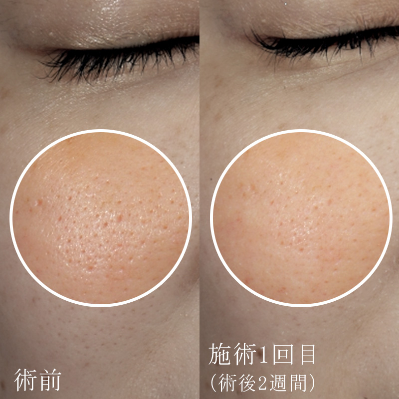 ブレッシング全顔（傾斜ニードルRF/ドラッグデリバリー）