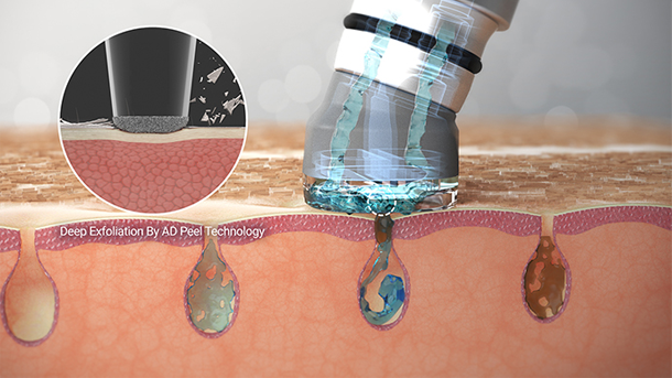 毛穴汚れと角質を吸引ピーリング