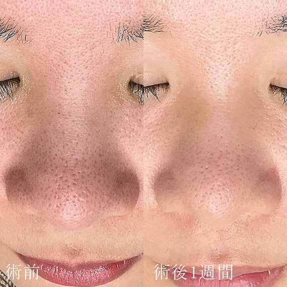 ミラノダーマ（ダーマペン４＋ミラノリピール）