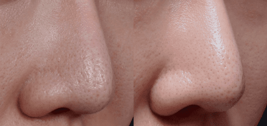 ピコフラクショナル1回照射