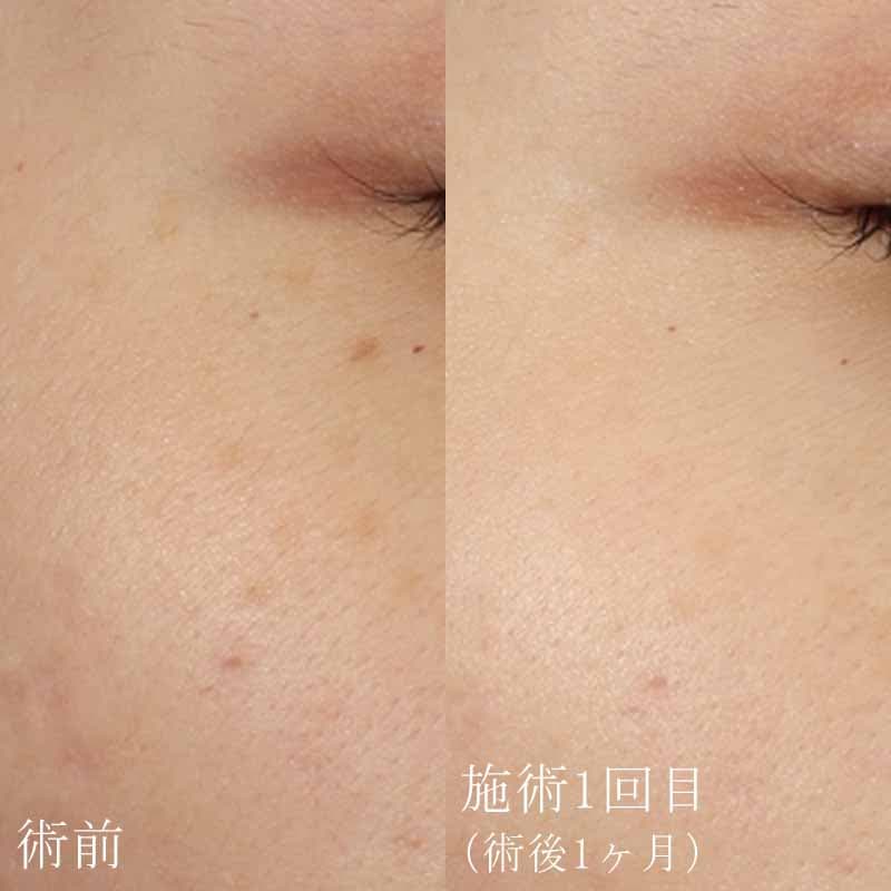 ピコスポット4回照射