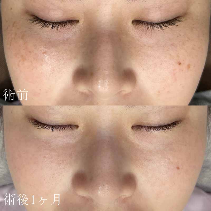 ピコスポット1回照射