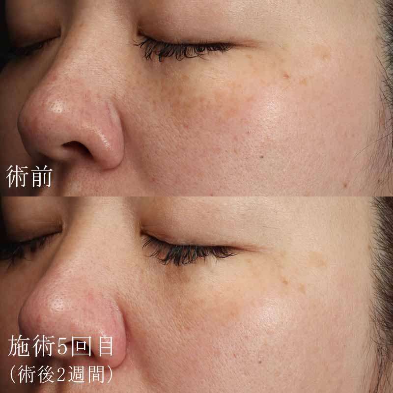 ピコトーニング3回照射