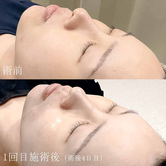 ヴェルべットスキン（ダーマペン4 +マッサージピール）