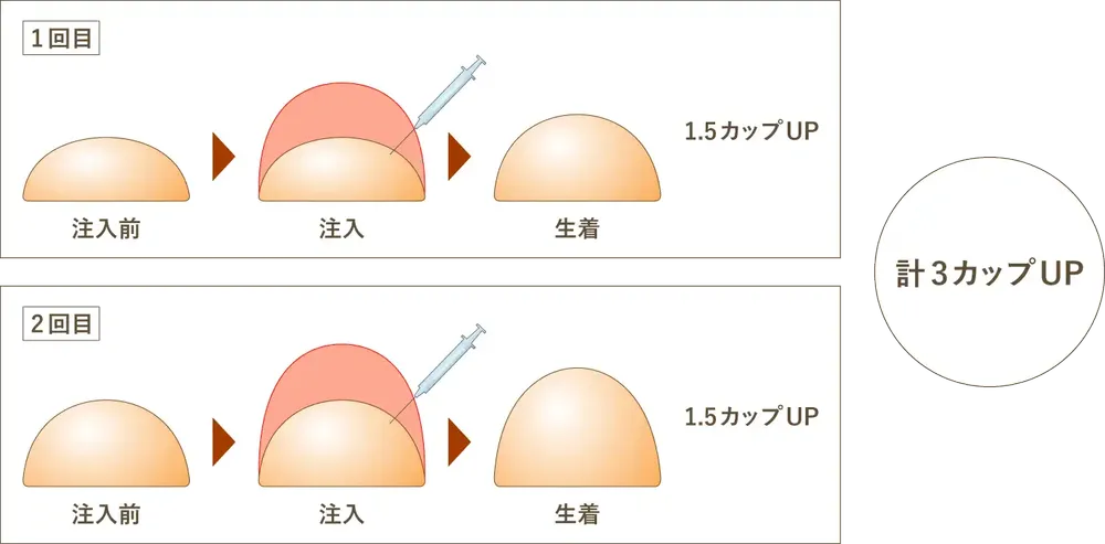 当院のピュアグラフト豊胸術