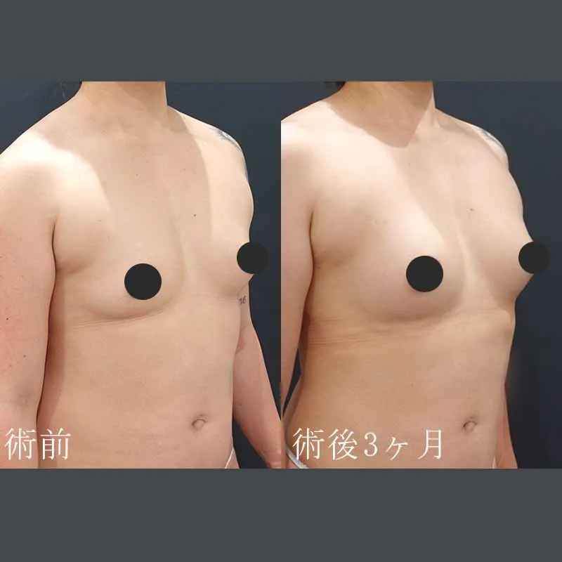 脂肪注入豊胸の症例写真④